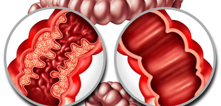 paciente con inflamacion intestinal